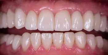 After dental treatment