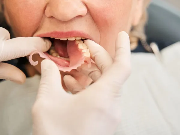 Replacing missing teeth